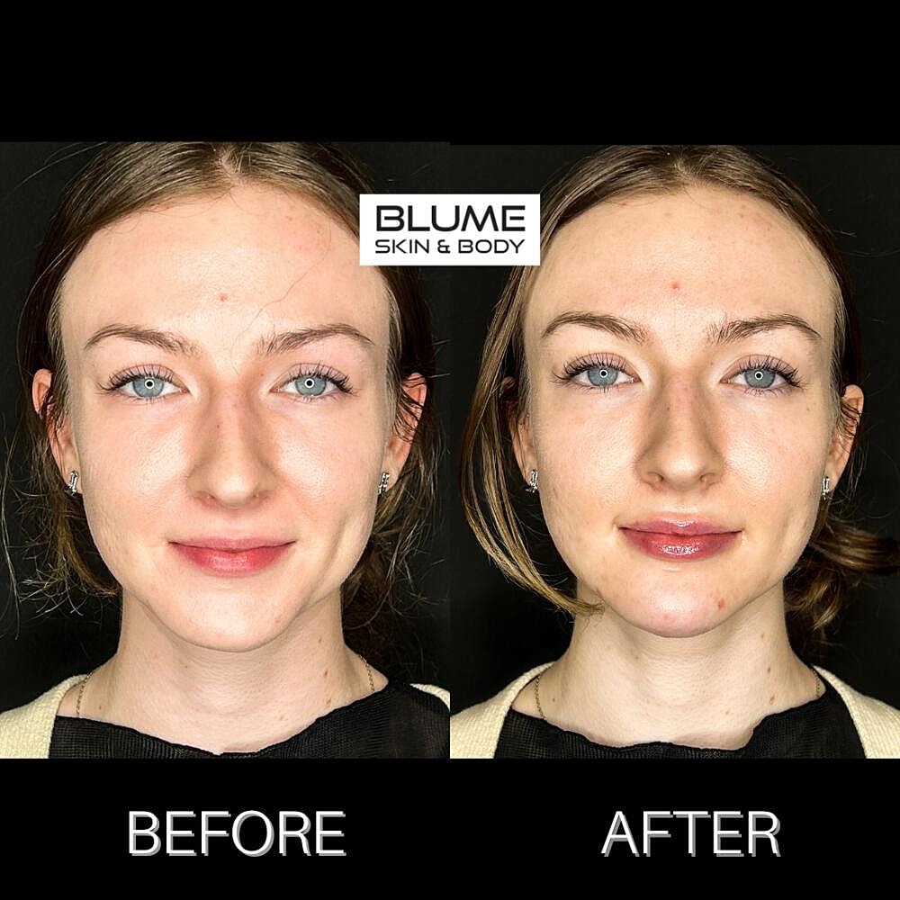 Dermal Fillers Before & After