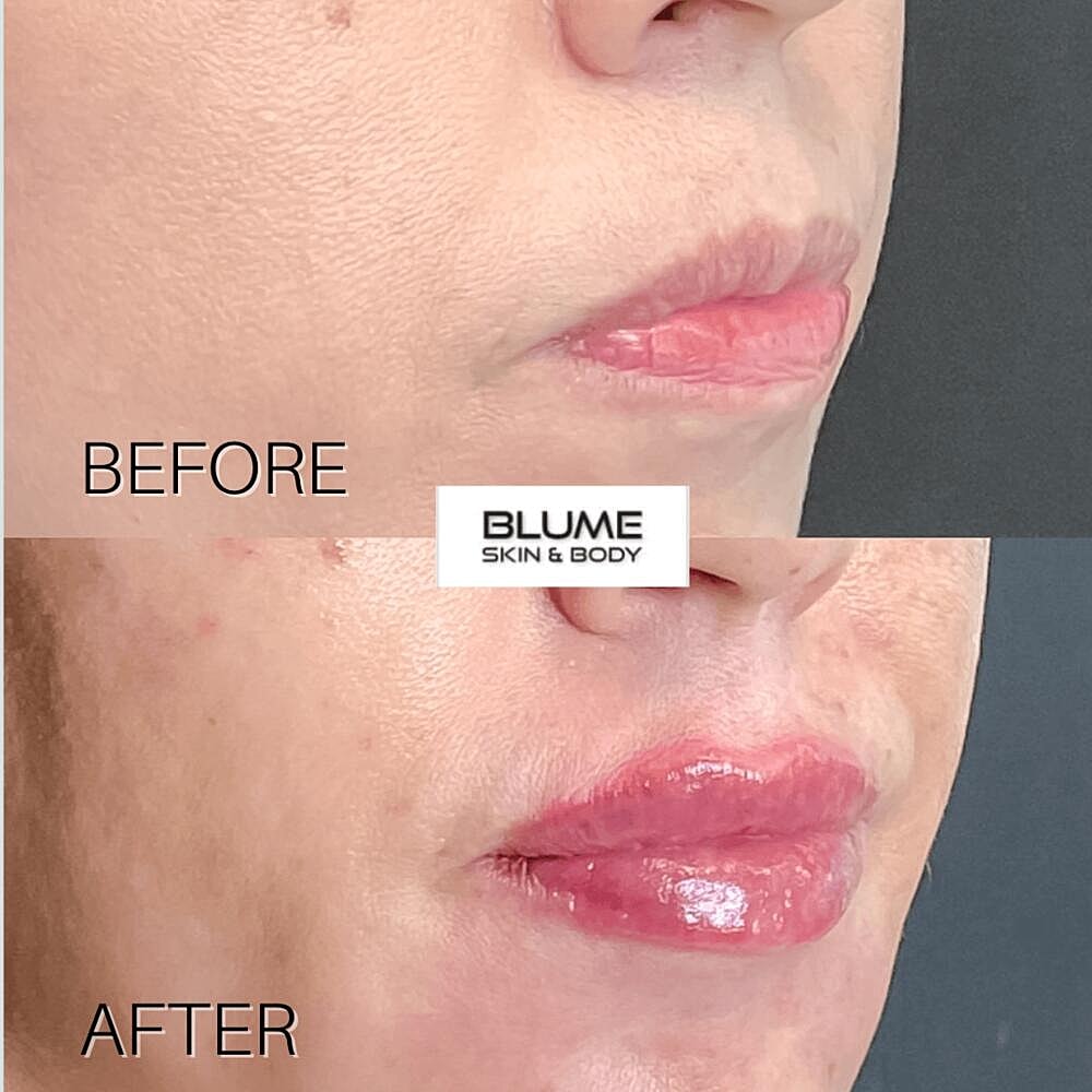 Dermal Fillers Before & After