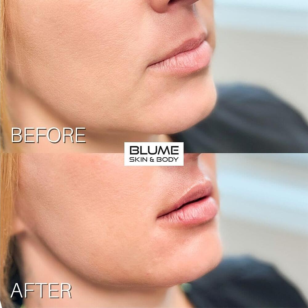 Dermal Fillers Before & After
