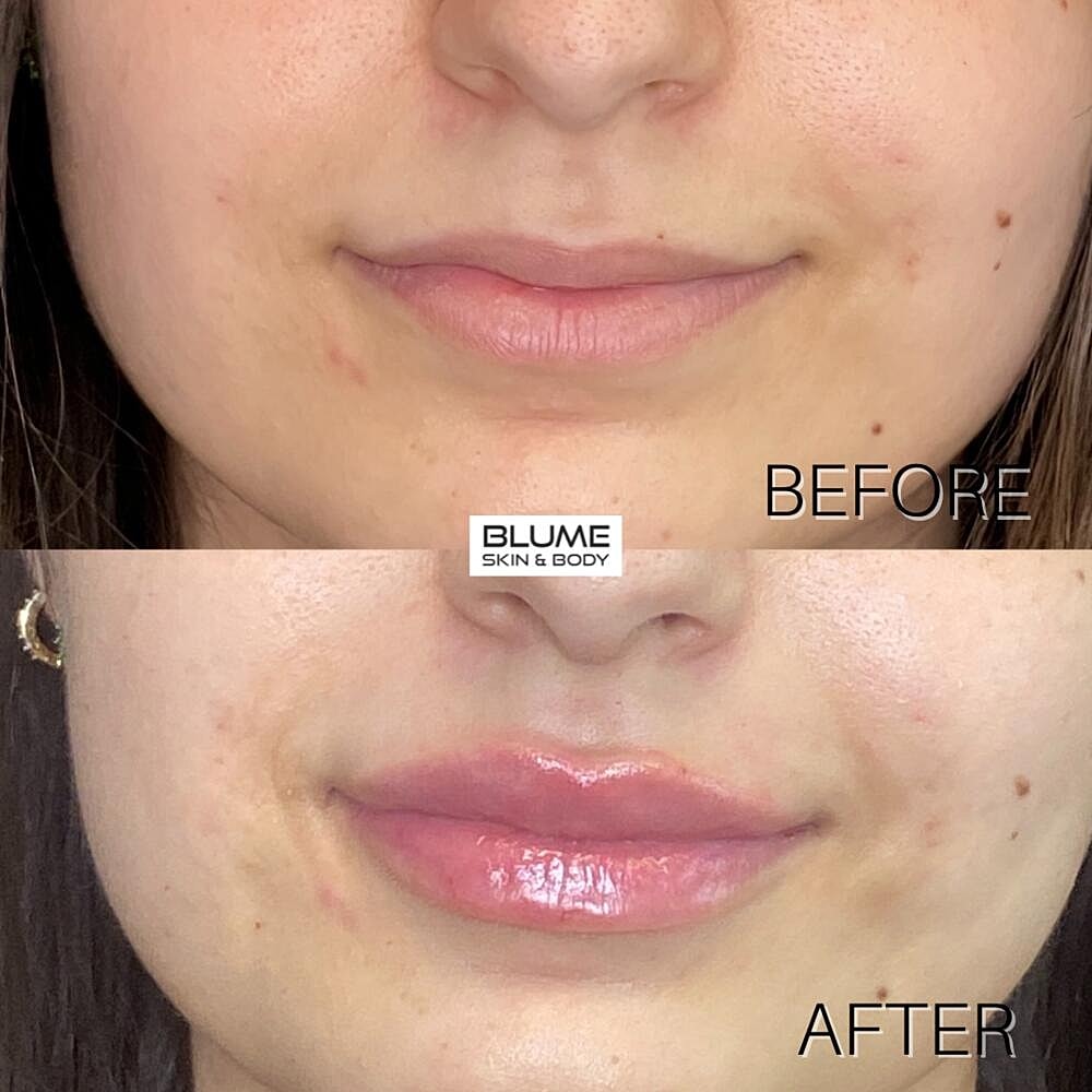 Dermal Fillers Before & After