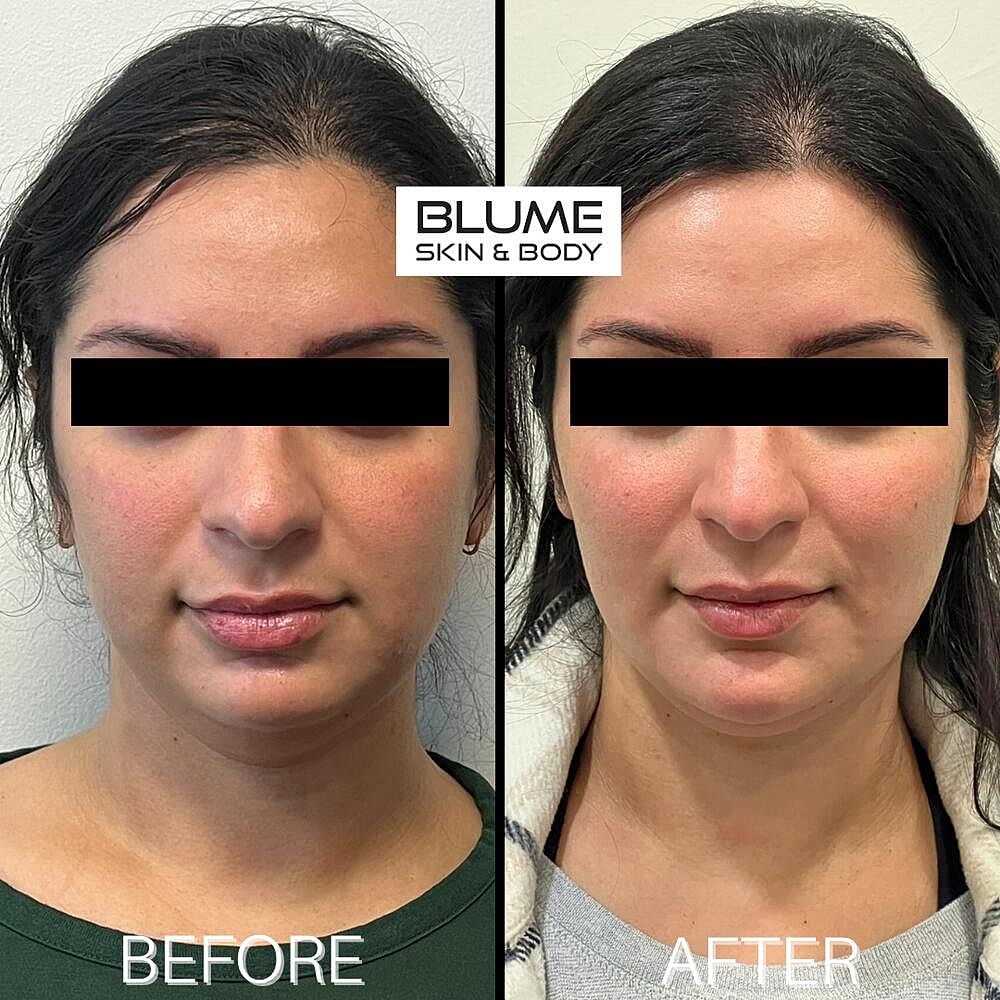 Dermal Fillers Before & After
