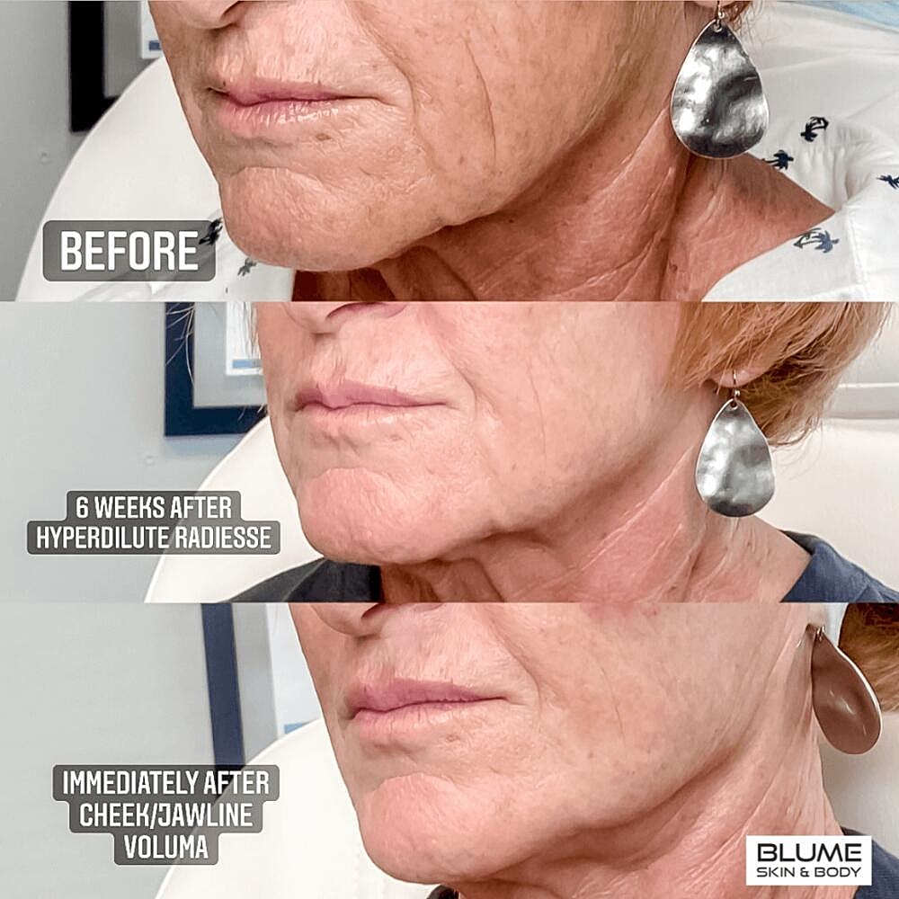 Dermal Fillers Before & After