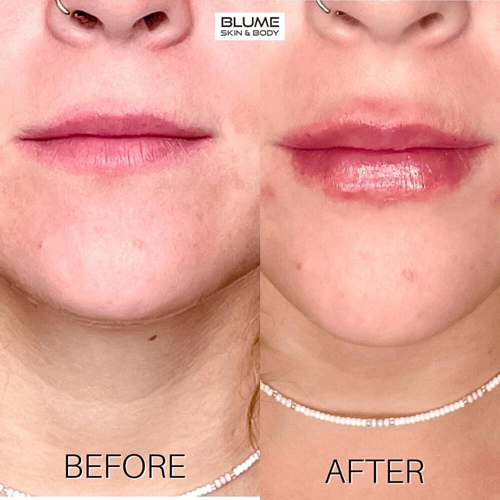 Dermal Fillers Before & After