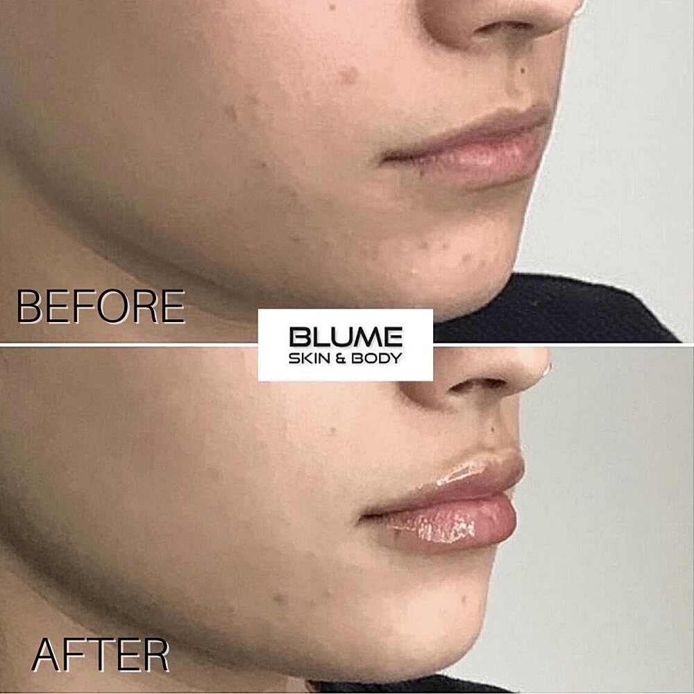 Dermal Fillers Before & After