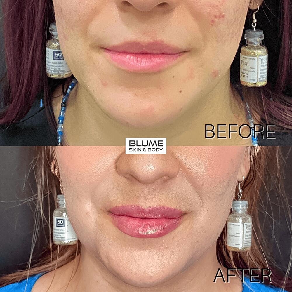 Dermal Fillers Before & After