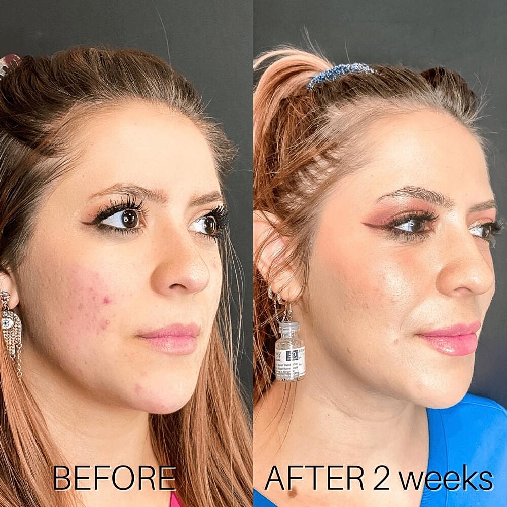 Dermal Fillers Before & After