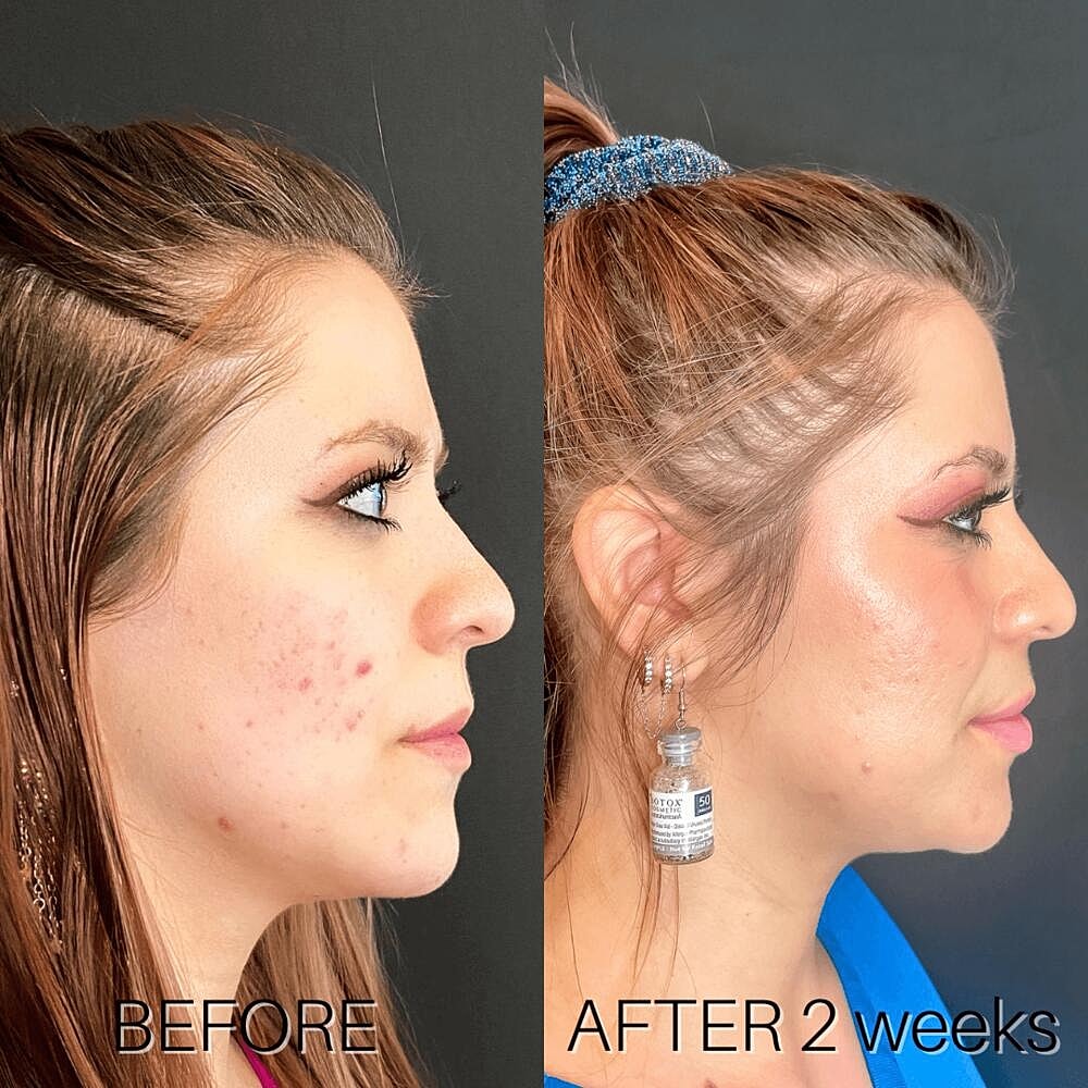 Dermal Fillers Before & After
