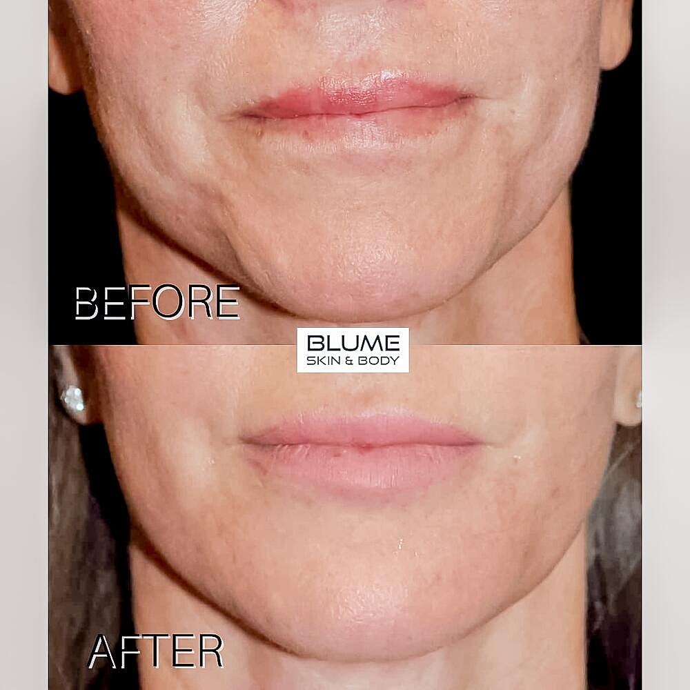 Dermal Fillers Before & After