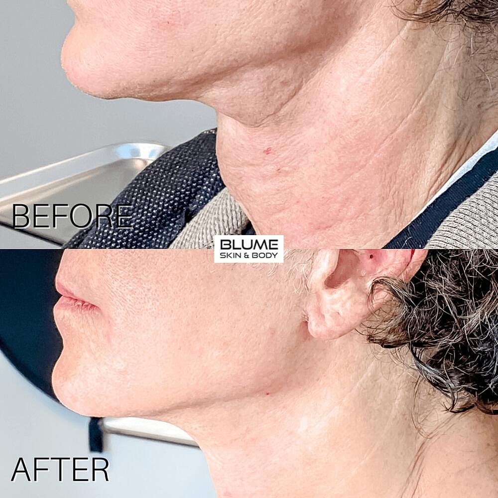 Dermal Fillers Before & After