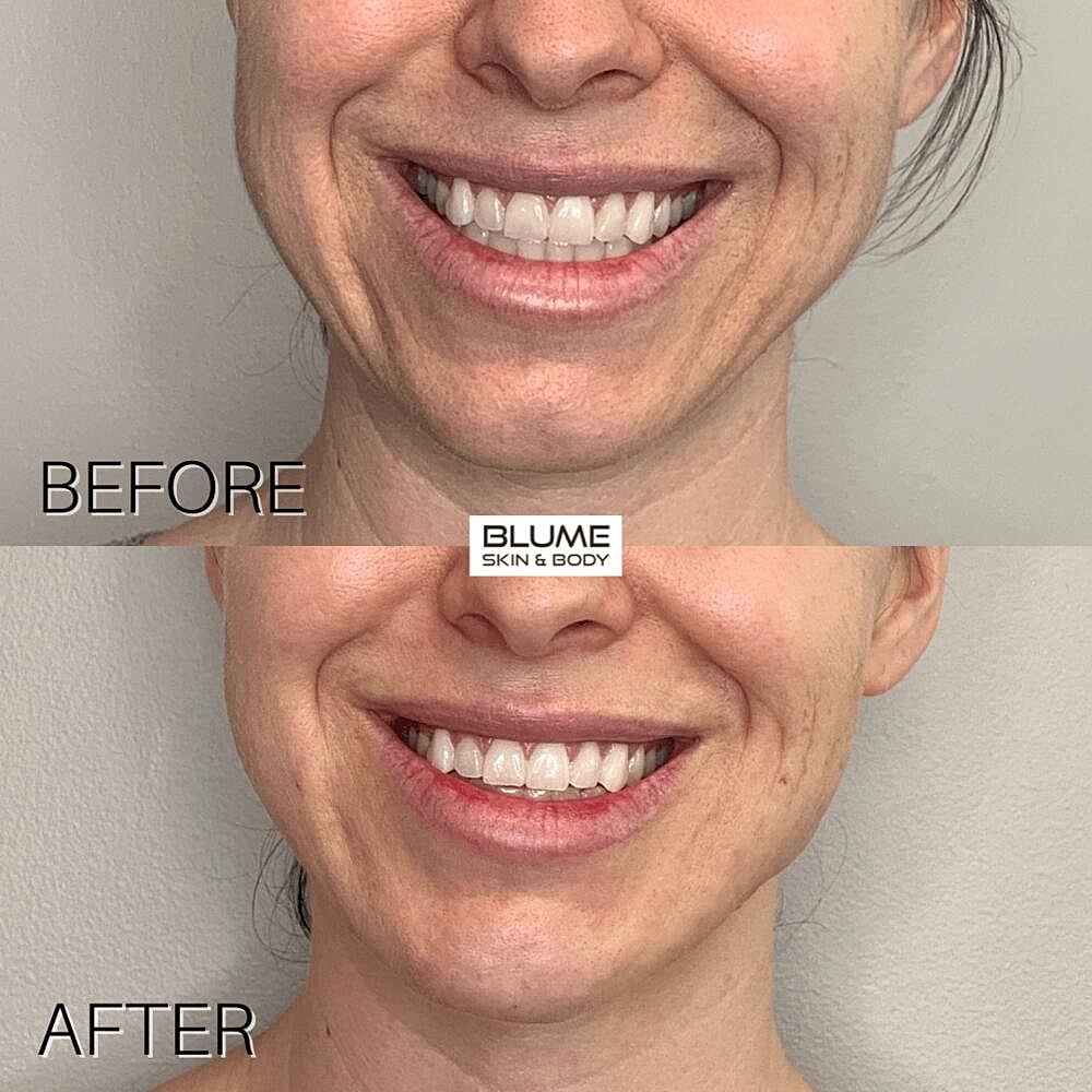 Dermal Fillers Before & After