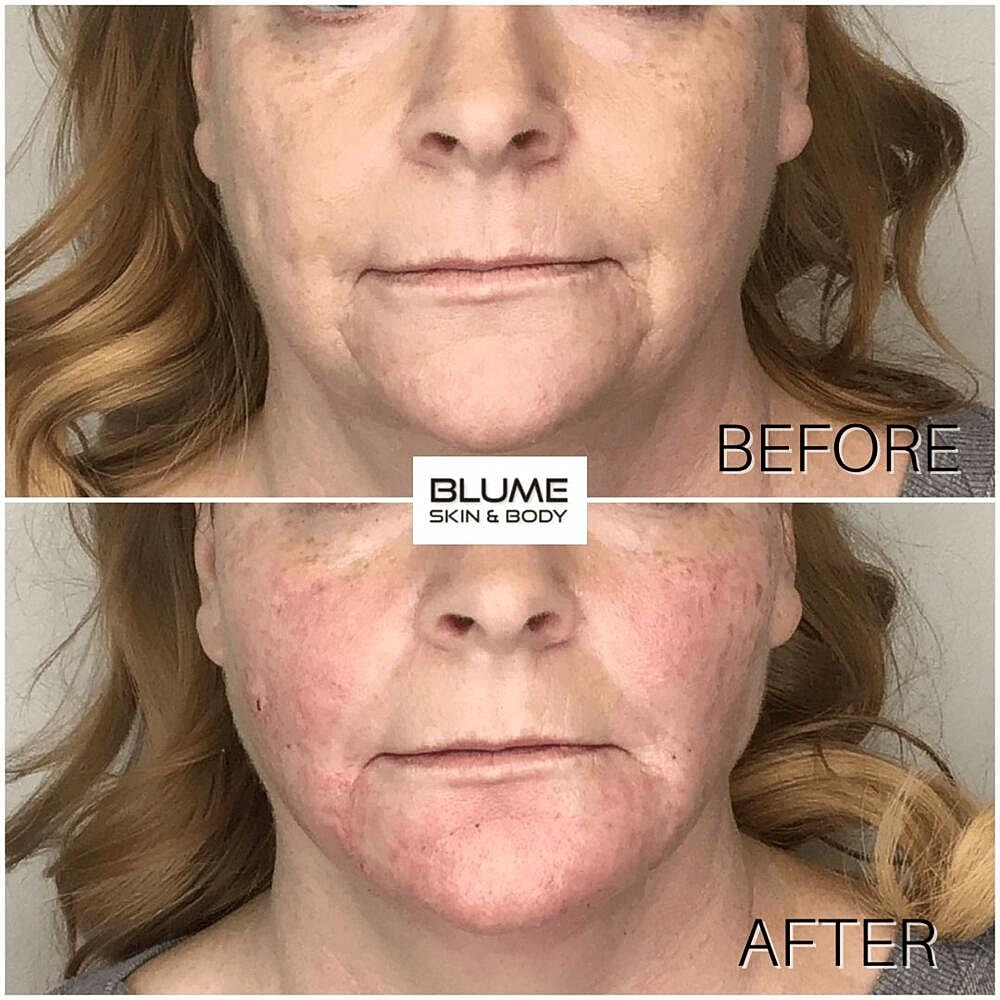 Dermal Fillers Before & After