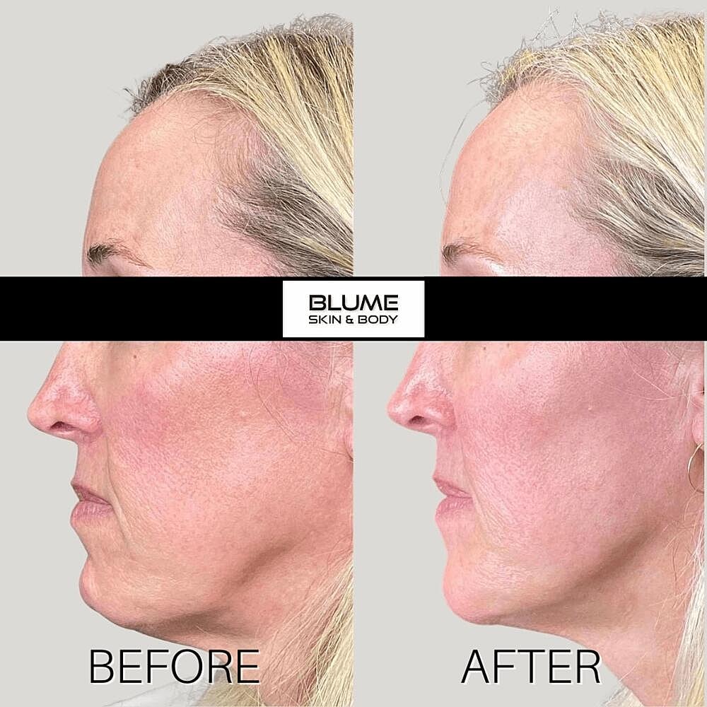 Dermal Fillers Before & After