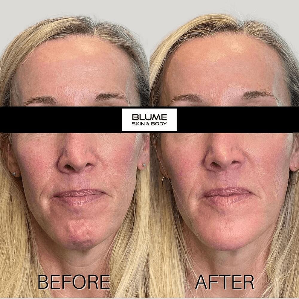 Dermal Fillers Before & After