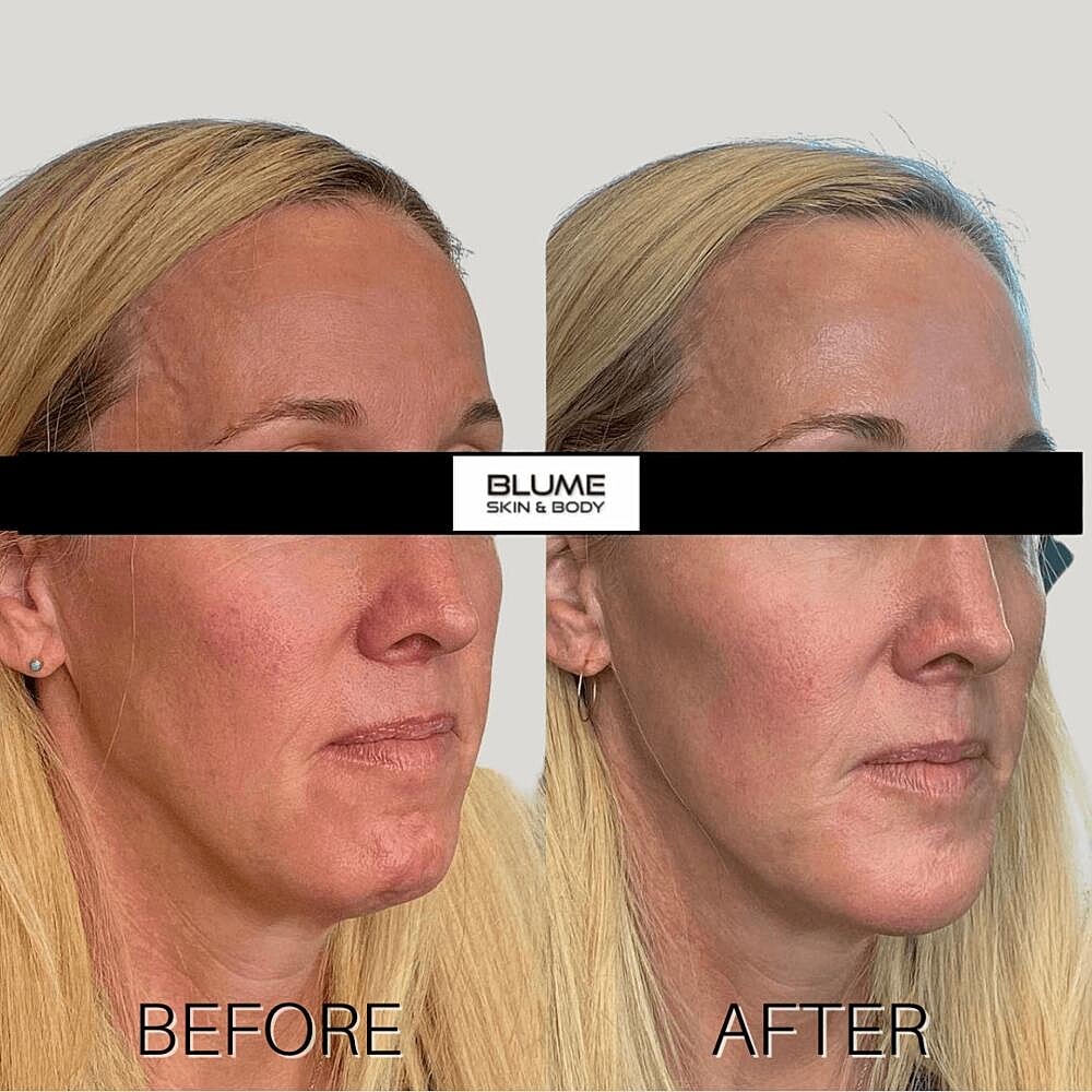 Dermal Fillers Before & After