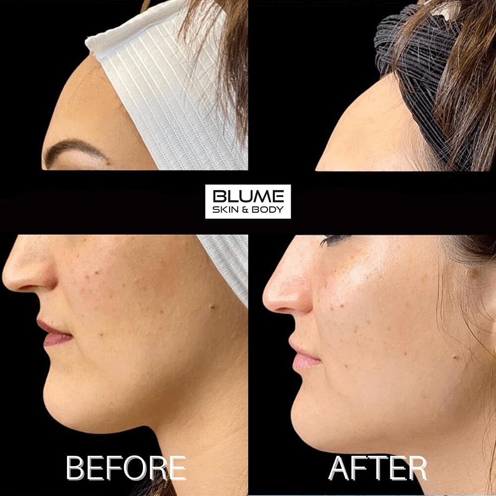 Dermal Fillers Before & After