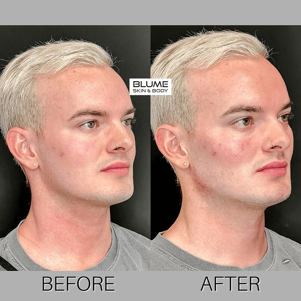 Dermal Fillers Before & After