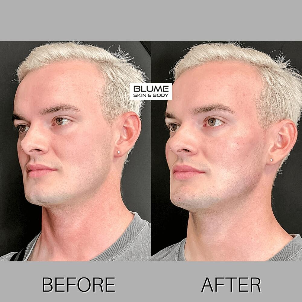 Dermal Fillers Before & After