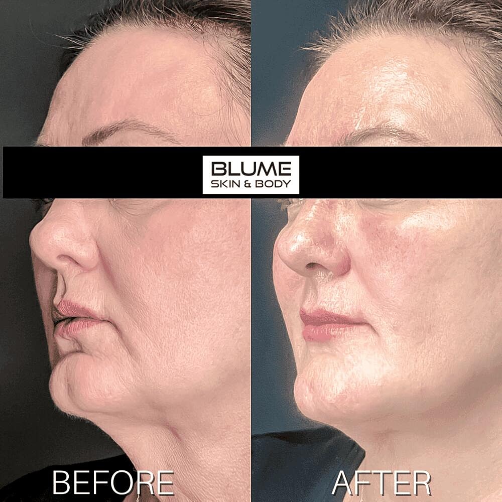 Dermal Fillers Before & After