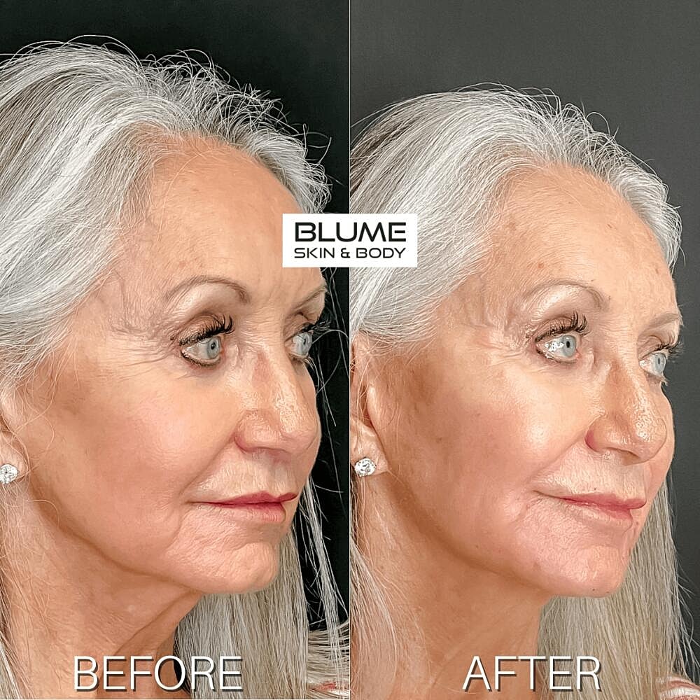 Dermal Fillers Before & After