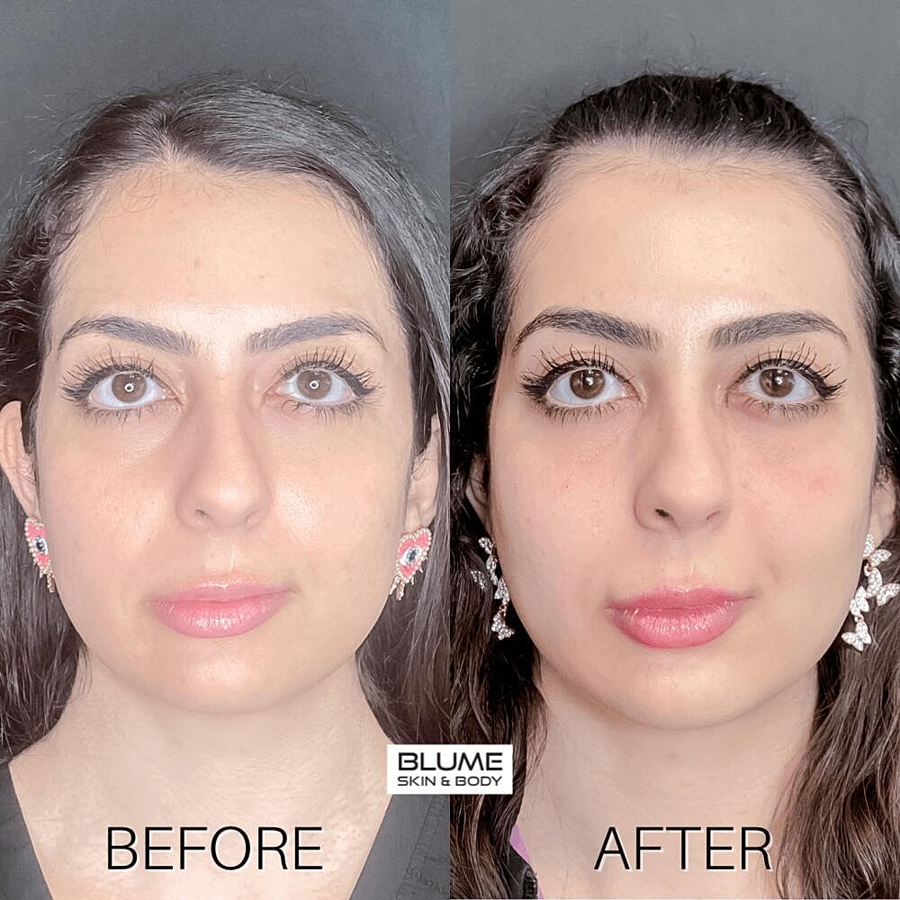 Dermal Fillers Before & After