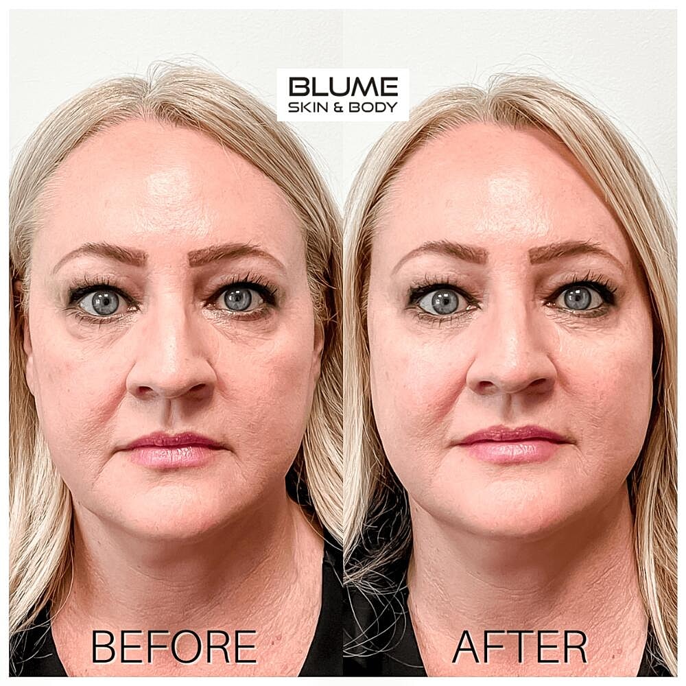 Dermal Fillers Before & After