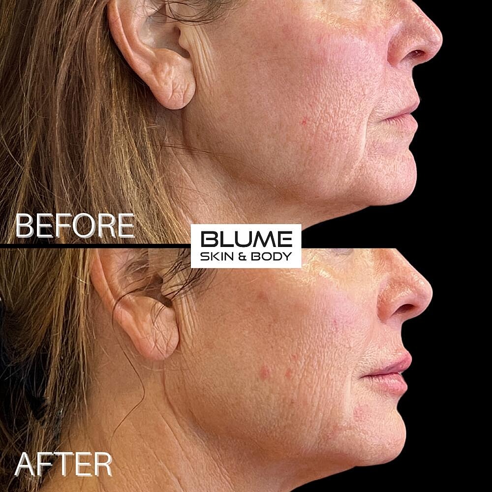 Dermal Fillers Before & After