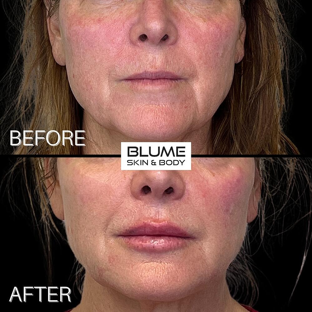 Dermal Fillers Before & After