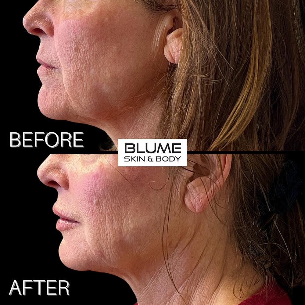 Dermal Fillers Before & After