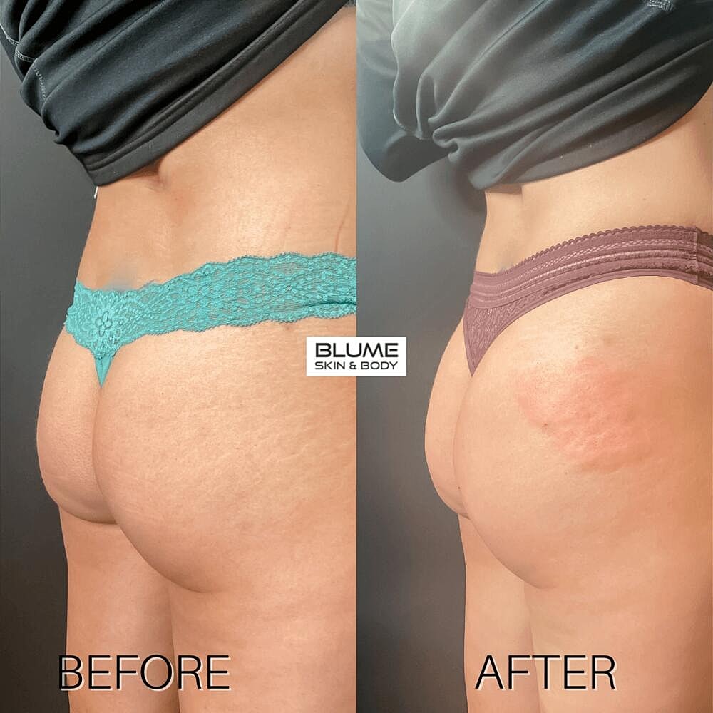 Dermal Fillers Before & After