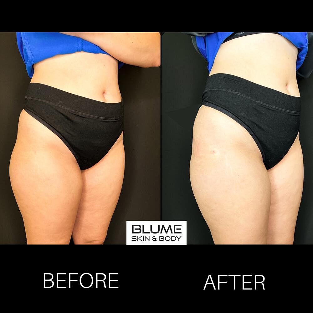 Dermal Fillers Before & After