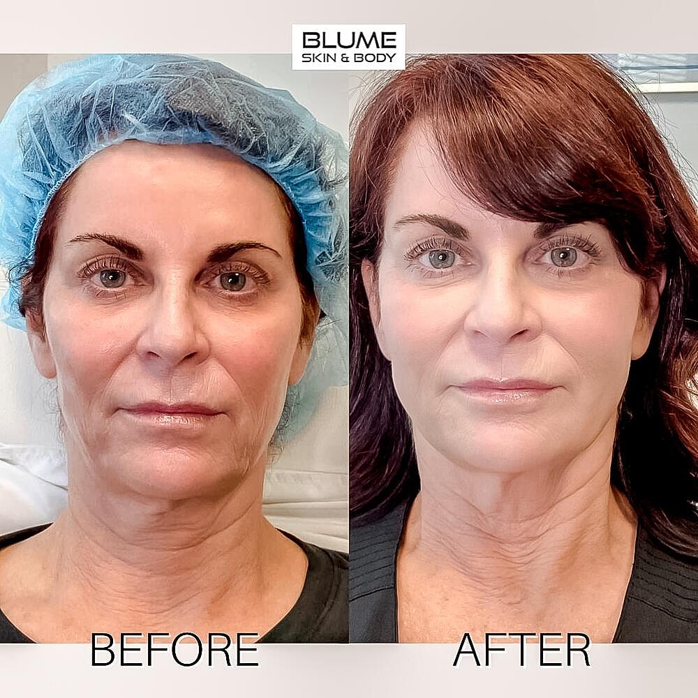 Dermal Fillers Before & After