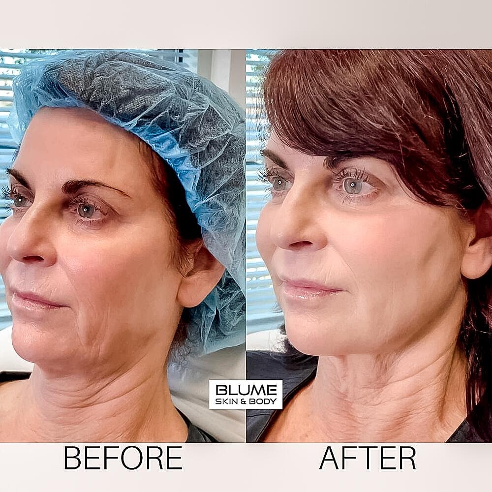 Dermal Fillers Before & After