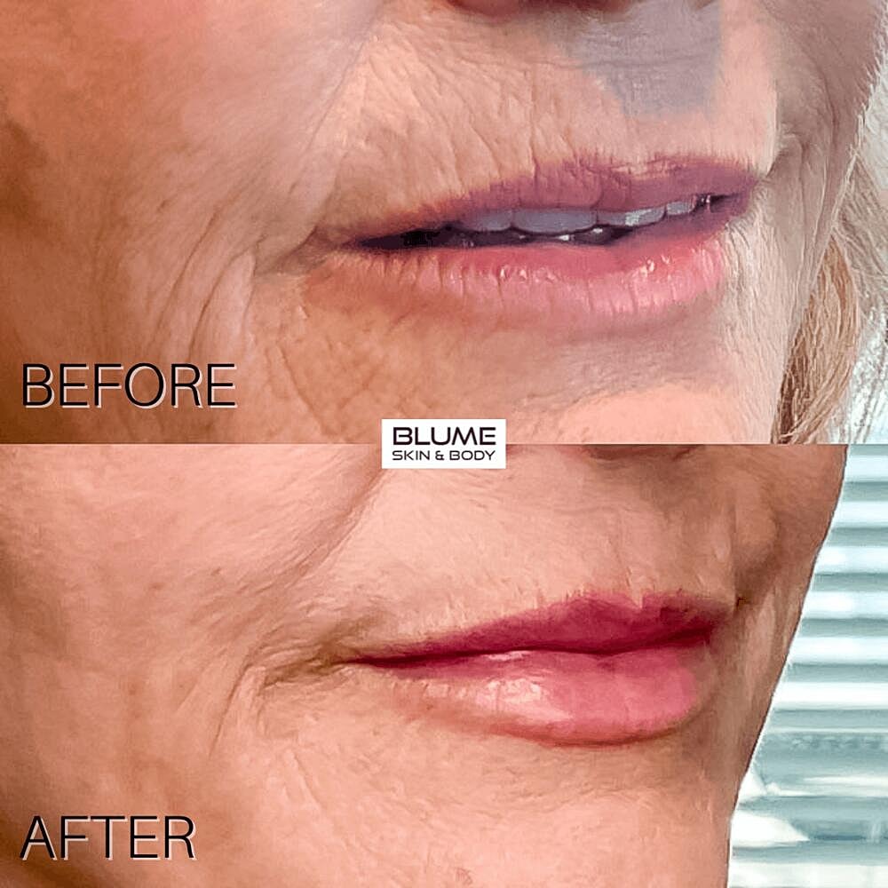Dermal Fillers Before & After