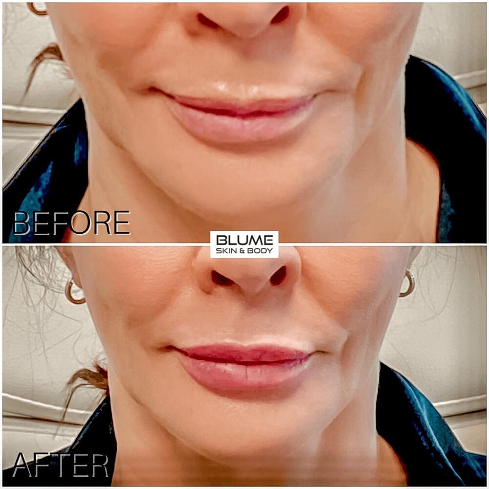 Dermal Fillers Before & After