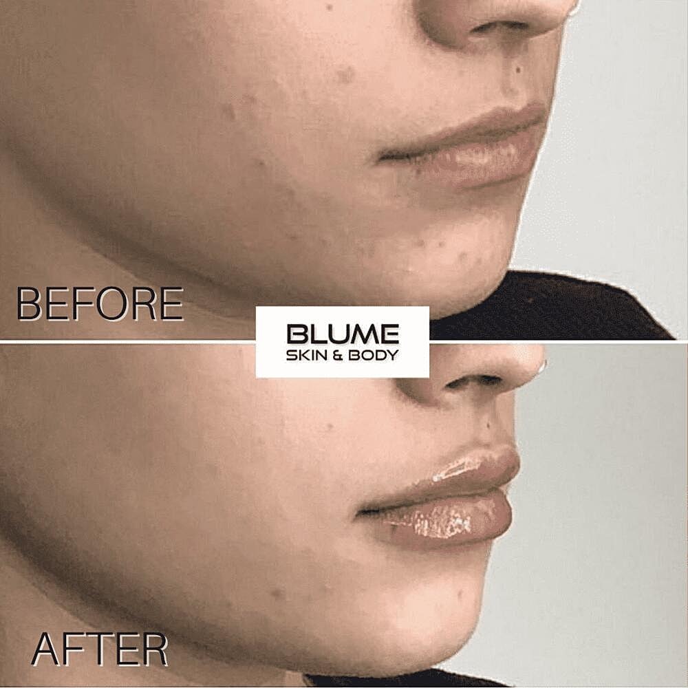 Dermal Fillers Before & After