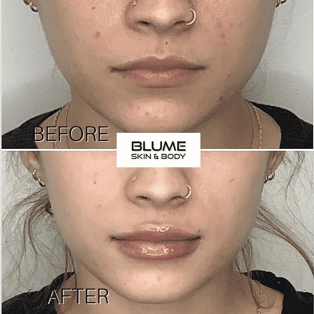 Dermal Fillers Before & After