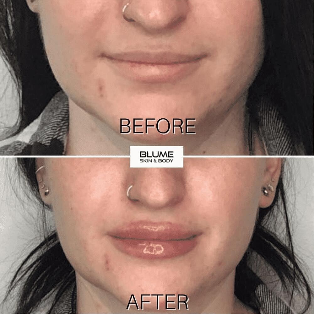 Dermal Fillers Before & After