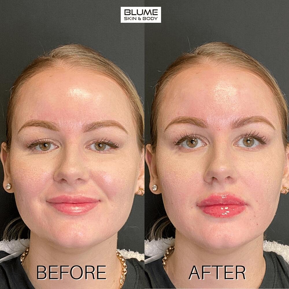 Dermal Fillers Before & After