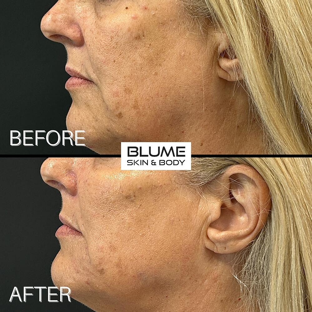 Dermal Fillers Before & After