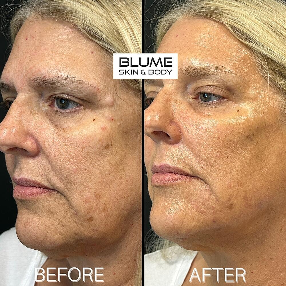 Dermal Fillers Before & After