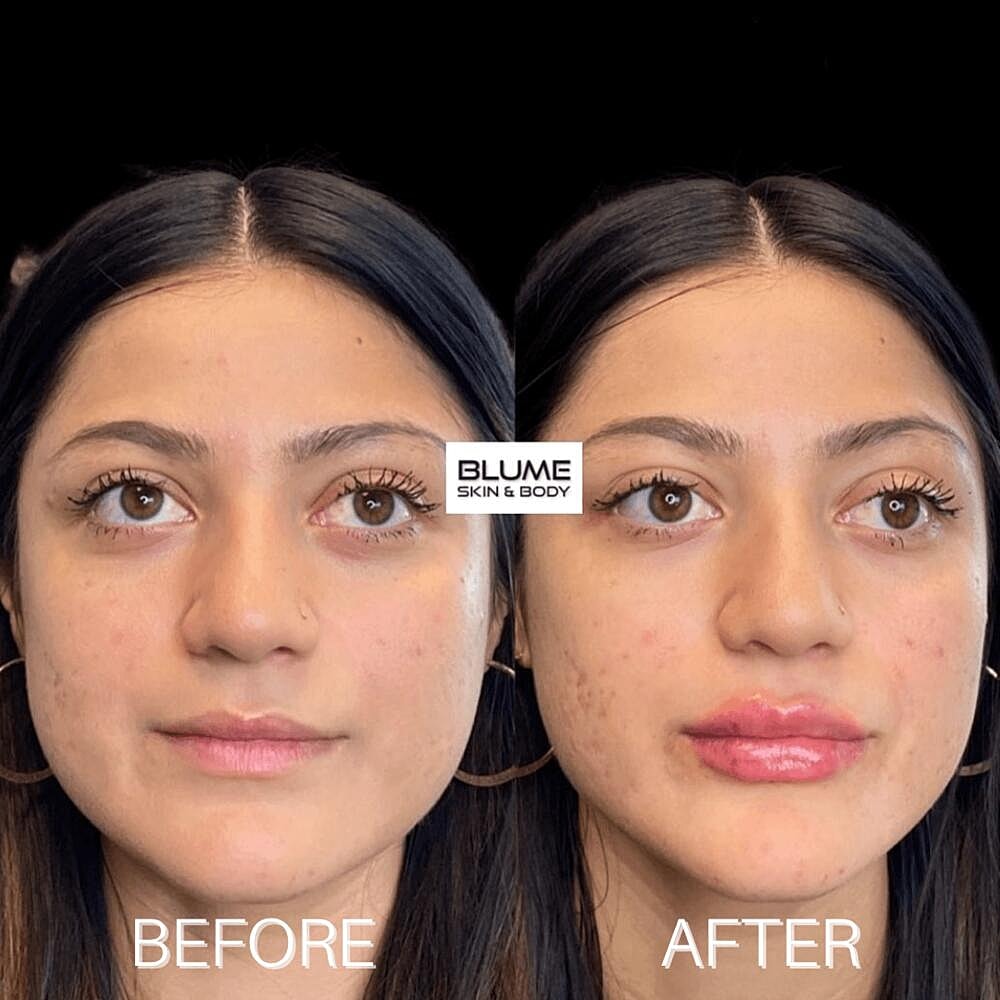 Dermal Fillers Before & After