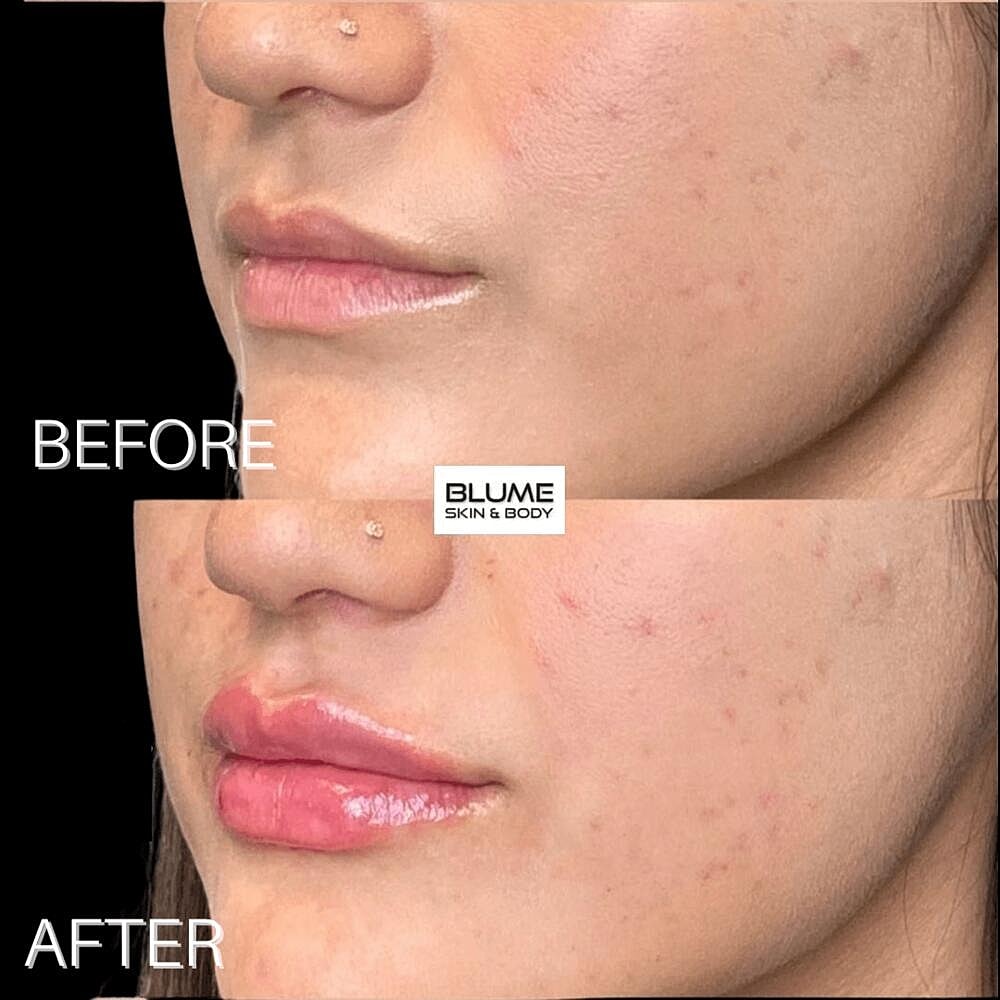 Dermal Fillers Before & After