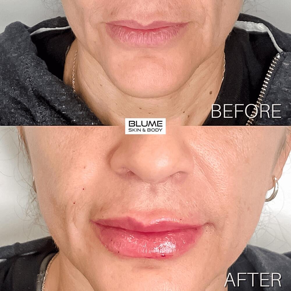 Dermal Fillers Before & After
