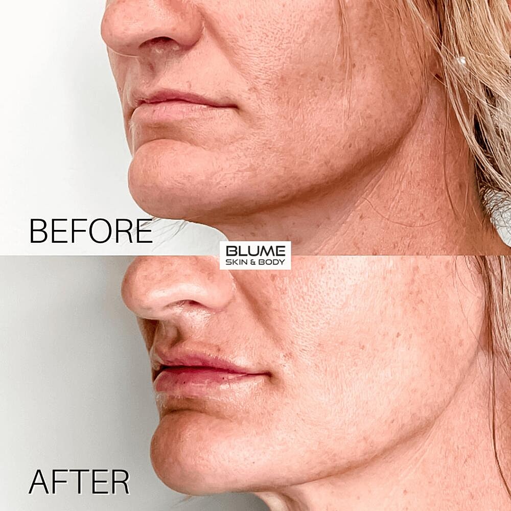 Dermal Fillers Before & After