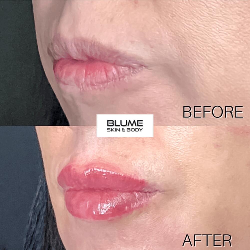 Dermal Fillers Before & After