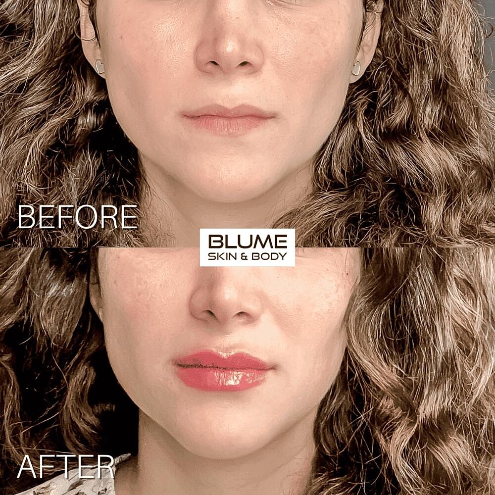 Dermal Fillers Before & After