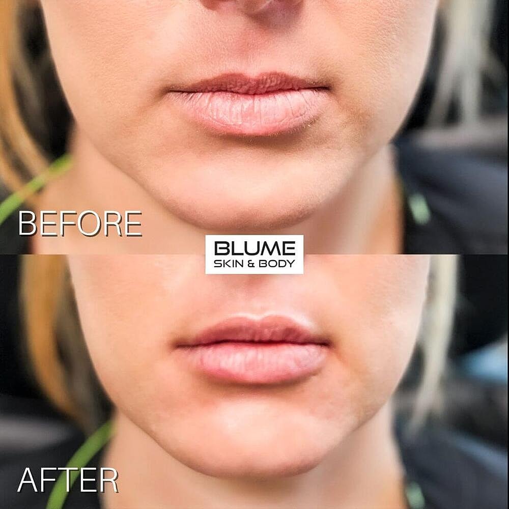 Dermal Fillers Before & After
