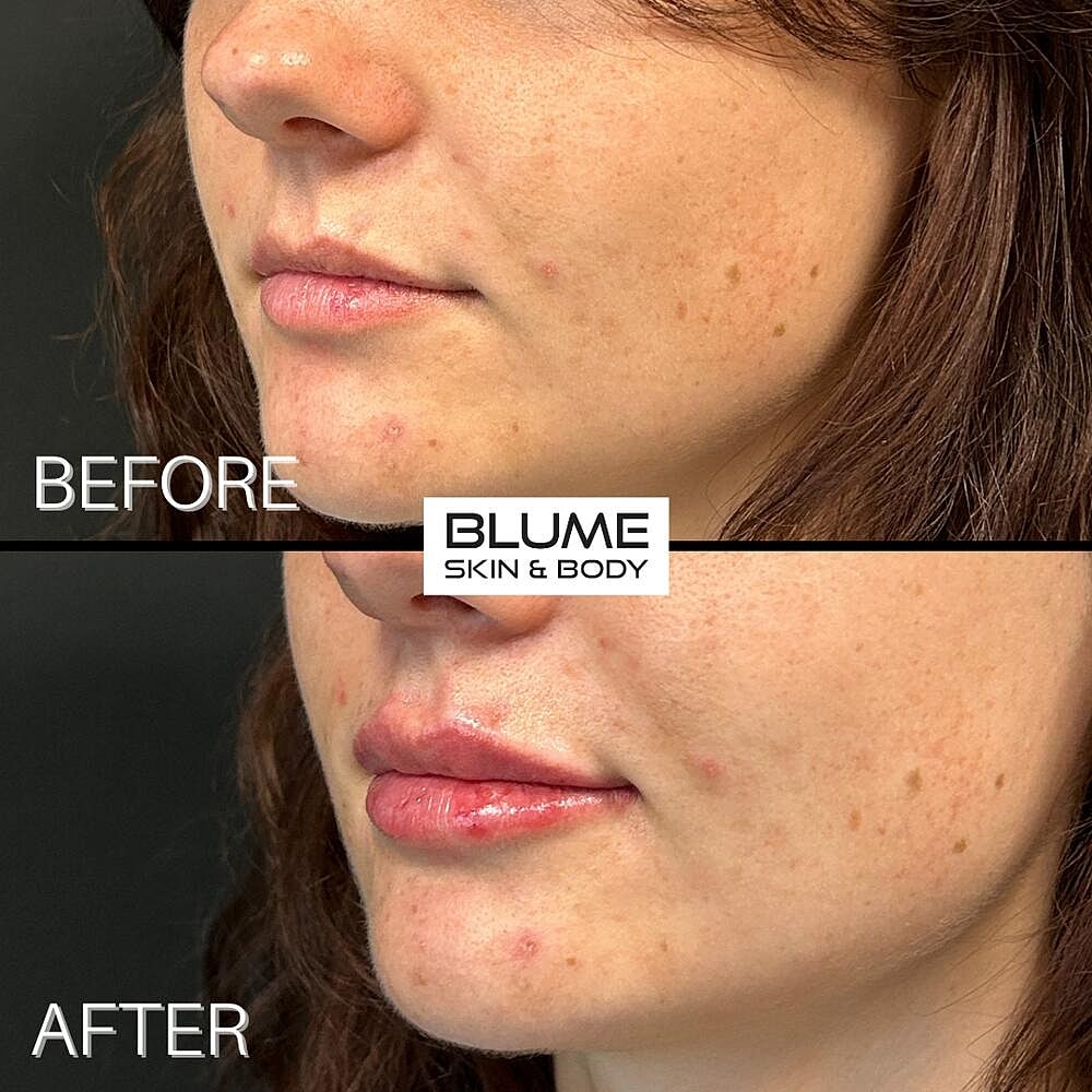 Dermal Fillers Before & After