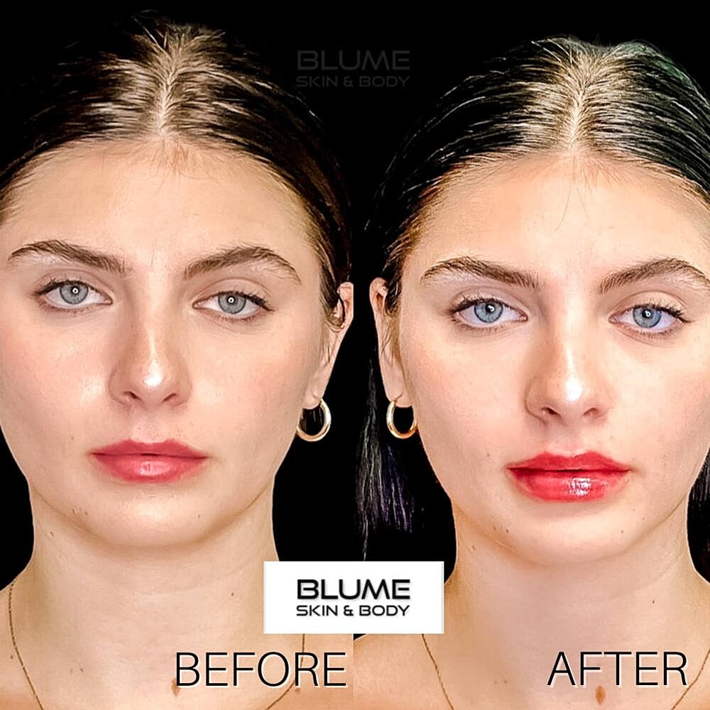 Dermal Fillers Before & After