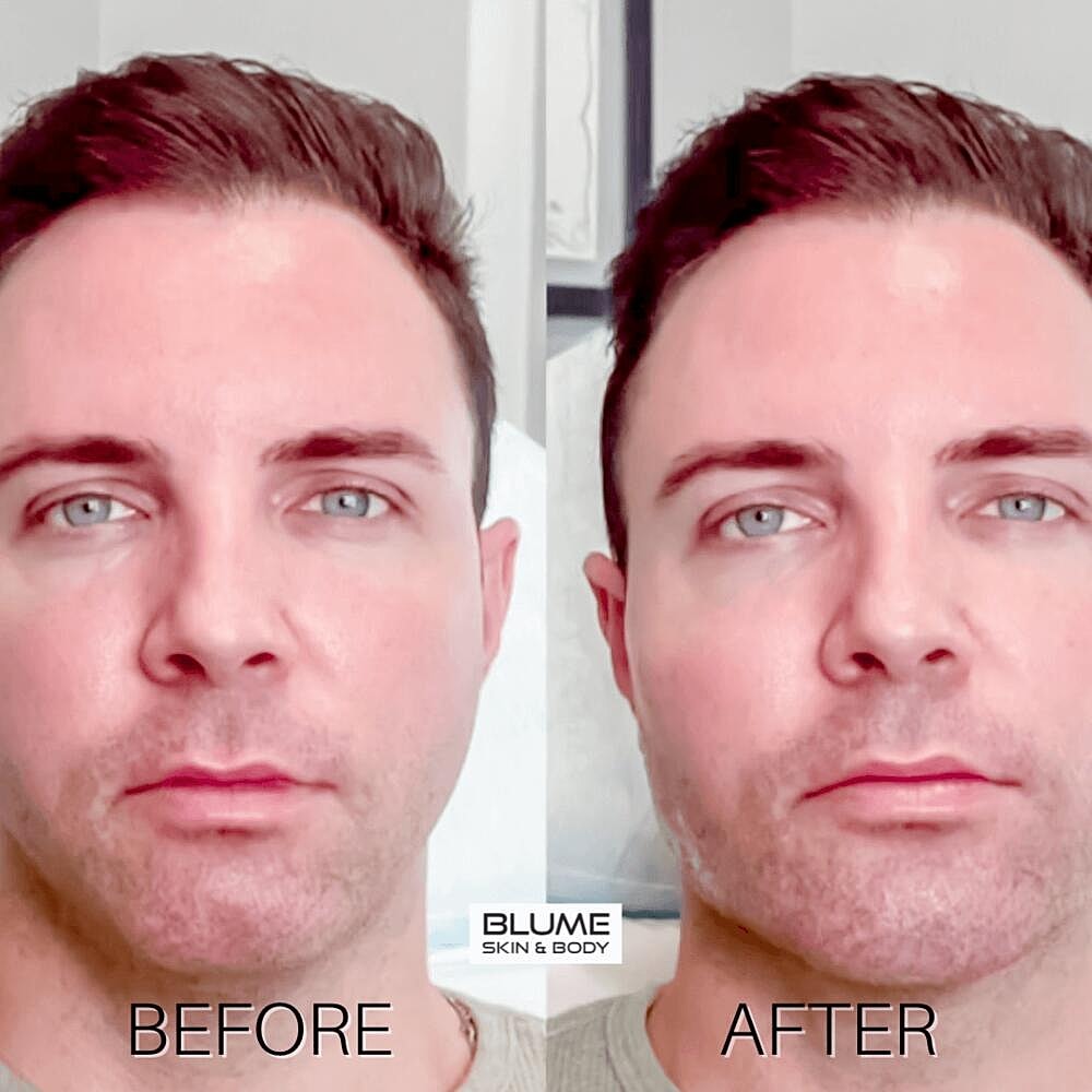 Dermal Fillers Before & After